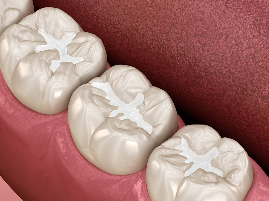 composite fillings near you