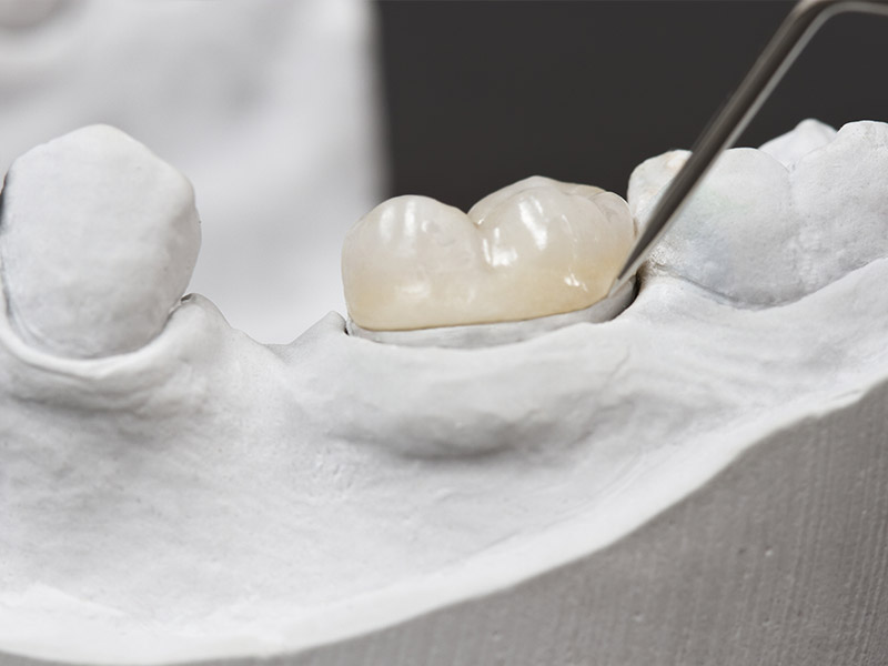 dental crowns in grande prairie