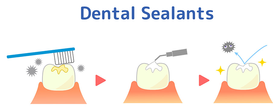 dental sealants in grande prairie