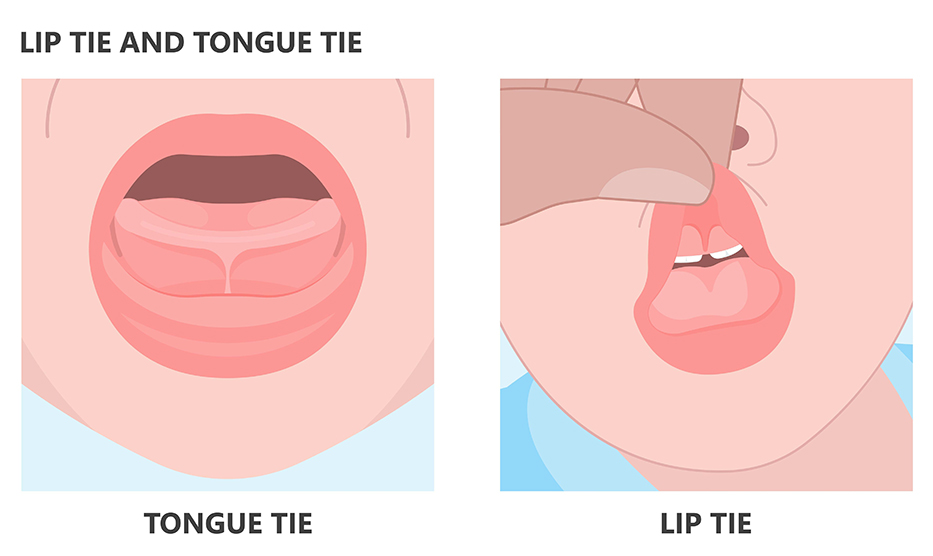 frenectomy in grande prairie